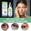 Picture of Stye Eye Treatment, Stye Eye Serum, 1 Fl.oz