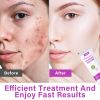 Picture of Acid 12% Facial Serum, Acid Face Cream, Skin Care