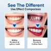 Picture of Teeth Whitening Kit -LED Light Tooth Whitener with Mouth Trays, Remineralizing Gel and Tray Case